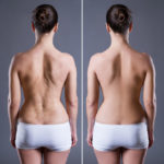 camouflage cicatrices et vergetures